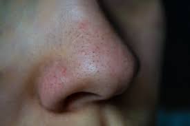 மூக்கில் கருமை மறைய..!!