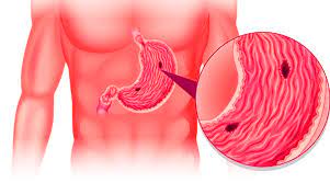 அல்சர் குணமாக பாட்டி வைத்தியம்!!!