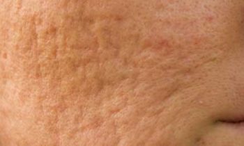 முகத்தில் உள்ள பள்ளங்கள் மறைய..!!