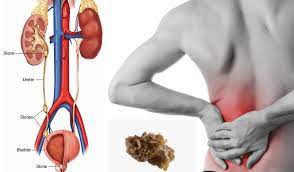 சிறுநீரக கல் கரைய வீட்டு வைத்தியம்..!!